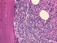 Follicular lymphoma-bone marrow biopsy - 3.