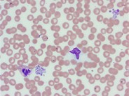 platelet clump in peripheral blood smear