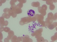 platelet clump in peripheral blood smear