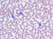 Infectious Mononucleosis Blood Smear