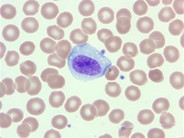 Infectious mononucleosis - 3.