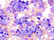 Marrow findings in JMML - 2.