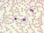 Sezary syndrome - peripheral smear - 2.