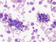 Burkitt leukemia - 1.