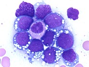 Burkitt leukemia - 3.