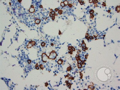 Plasma cell myeloma - Russell bodies