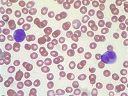 Acute Promyelocytic Leukemia, microgranular