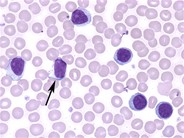 T-cell prolymphocytic leukemia - 3.