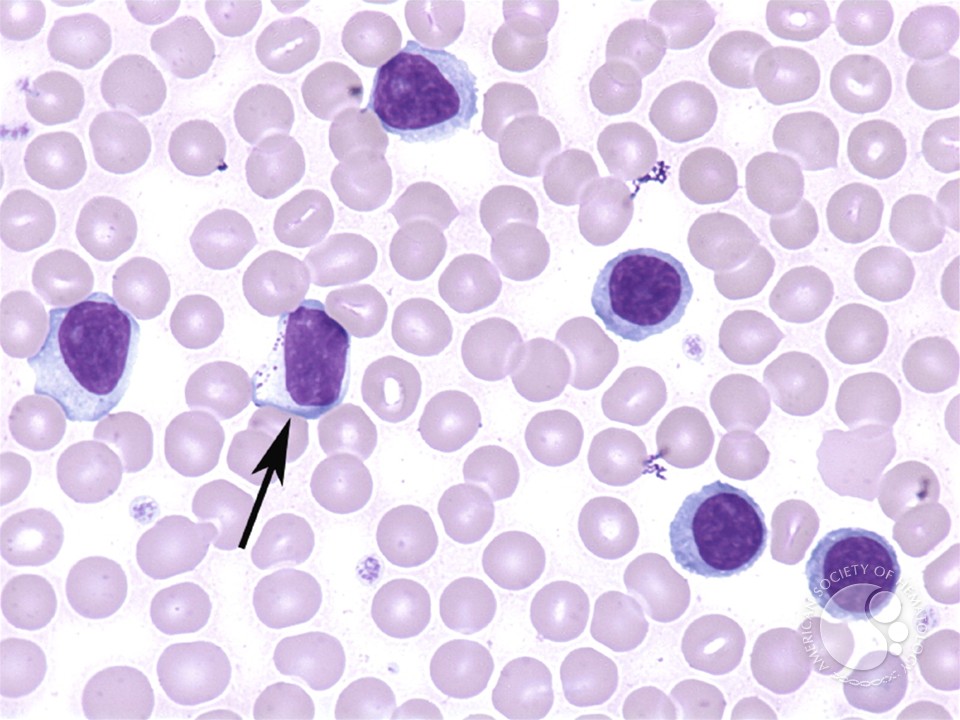 Реактивные лимфоциты в крови. Лимфоциты гистология. Плазмобластный лейкоз. Широкоплазменные лимфоциты. Лимфоциты в крови микроскопия.