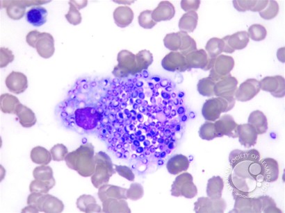 Histoplasma capsulatum in macrophage in bone marrow - 1.
