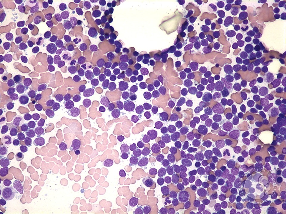 Relapsed T-cell ALL - 1.