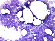 Acute monocytic leukemia - 1.