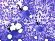 Dysplastic megakaryocytes - 1.