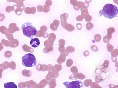 Dysplastic monocytes - 1.