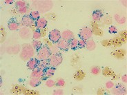 Refractory anemia with ringed sideroblasts and thrombocytosis (RARS-T) - Prussian blue iron stain - 2.