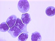 Mantle cell lymphoma CSF