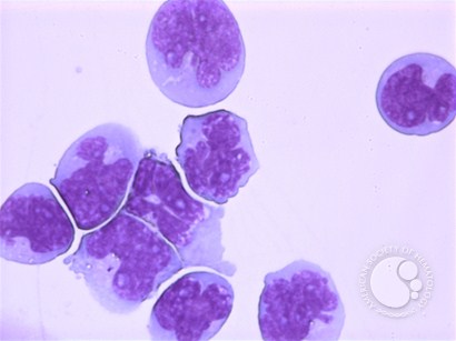 Mantle cell lymphoma - CSF