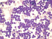 AML without maturation - 2.