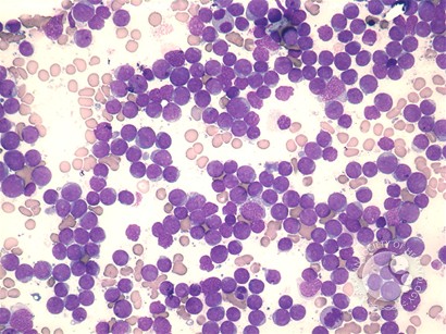 AML without maturation - 2.