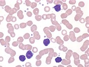 Adult T-cell leukemia / lymphoma