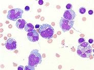 large-b-cell-lymphoma-presenting-as-a-pleural-effusion-2