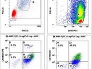 Large B-cell lymphoma presenting as a pleural effusion - 3