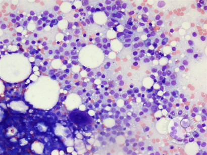 Hairy cell leukemia - 1.
