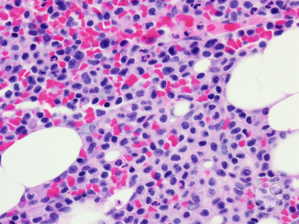 Hairy cell leukemia - 3.