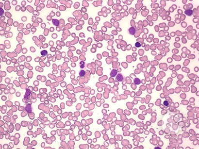 Marginal zone lymphoma: leukemic phase - 1.