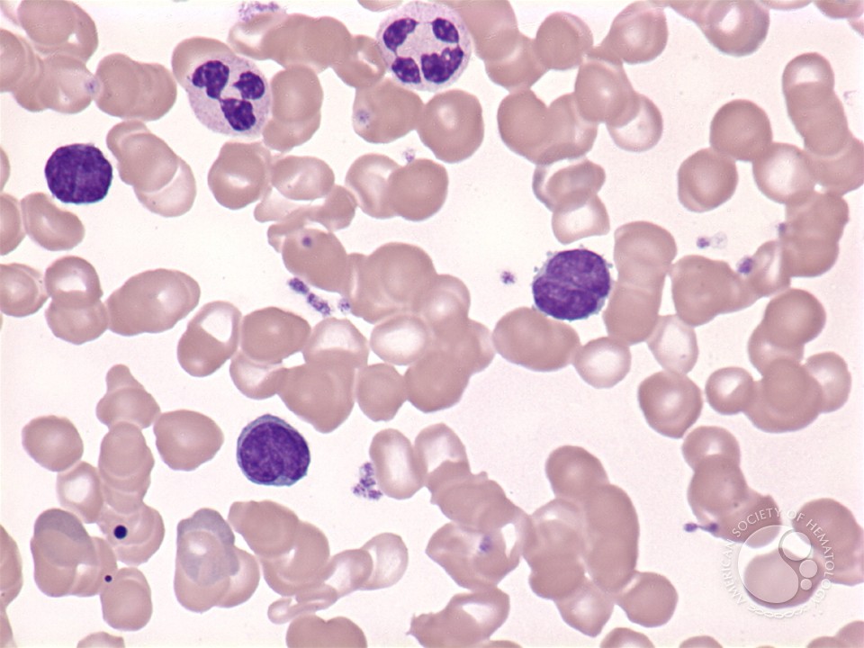 Marginal zone lymphoma: leukemic phase - 2.