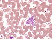 Essential thrombocythemia: peripheral smear - 1.