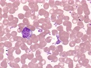 Essential thrombocythemia: peripheral smear - 4.