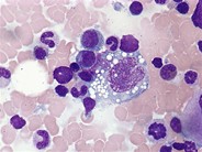 Anaplastic large cell lymphoma - bone marrow aspirate - 2.