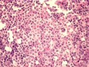 AML with maturation - 7.