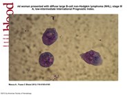 non hodgkins lymphoma cells