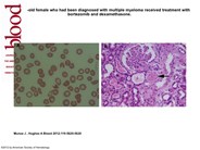 TTP after autologous stem cell trasnplantation