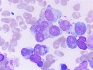 Heavily granulated myeloma cells; some granules are Auer rod-like - 1.