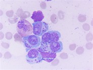 Heavily granulated myeloma cells; some granules are Auer rod-like - 2.