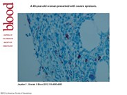 Atypical mycobacteria in a patient with HIV and ITP