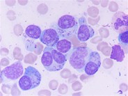 Heavily granulated myeloma cells; some granules are Auer rod-like - 3.