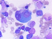 Heavily granulated myeloma cells; some granules are Auer rod-like - 4.