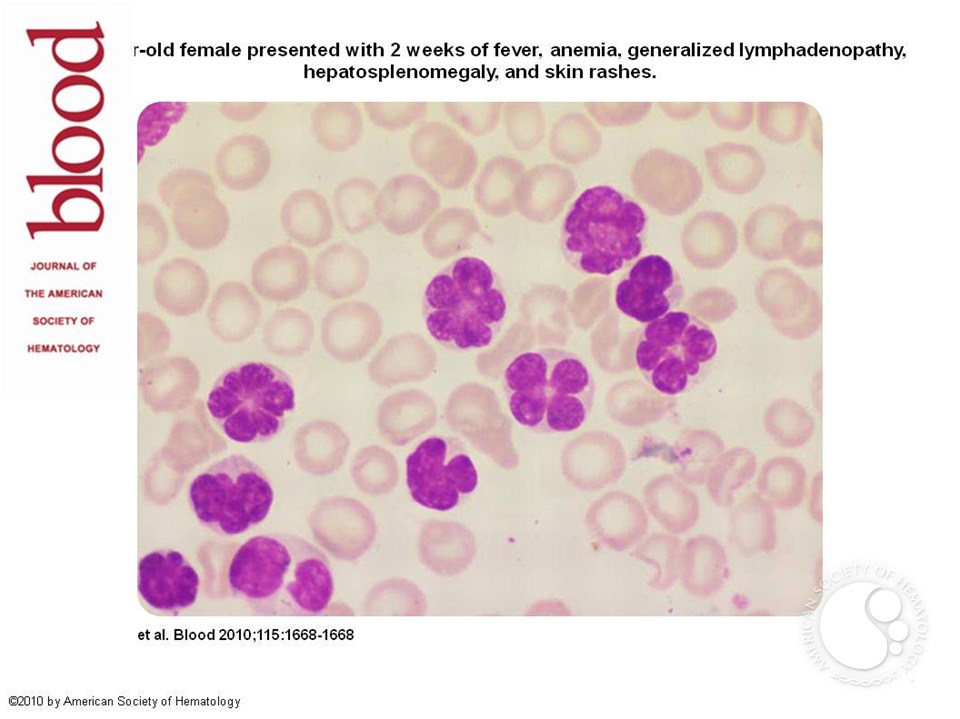Flower cells of leukemia