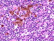 Melanoma metastatic to the bone marrow - 3.