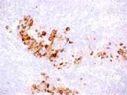 Melanoma metastatic to the bone marrow - 4.