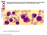 Erythroid leukemia evolving from Multiple Myeloma