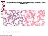 Pappenheimer bodies in a splenectomized patient with alcohol abuse