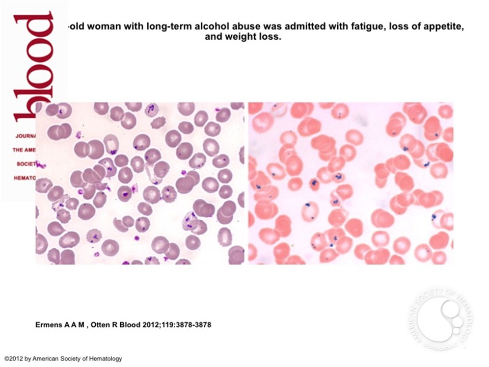 Pappenheimer bodies in a splenectomized patient with alcohol abuse Pappenheimer bodies in a splenectomized patient with alcohol abuse