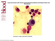 Pseudo-Auer rods in a patient with newly diagnosed IgG myeloma