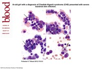 Accelerated phase of Chediak-Higashi syndrome