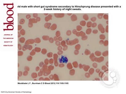 Yeast-like intraleukocytic inclusions in a peripheral smear